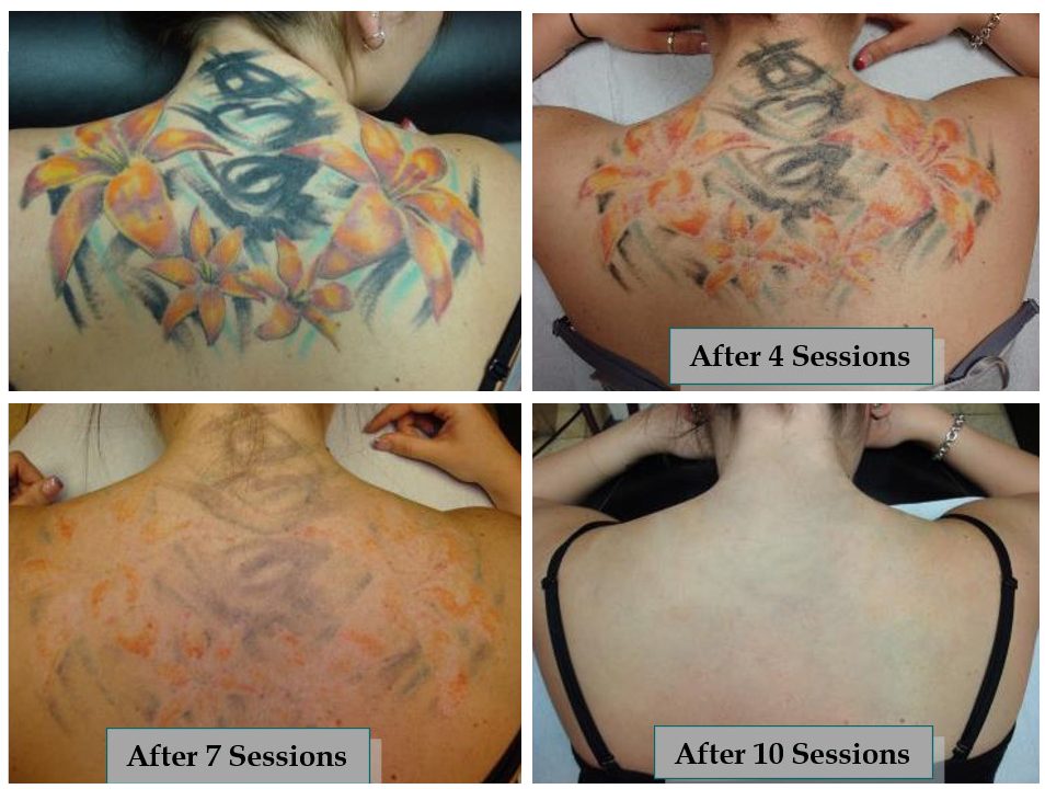 Tattoo Removal How It Works Process Healing  Scarring