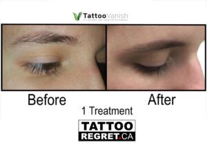 Before and After Tattoo Removal - Get the Best Res (10)