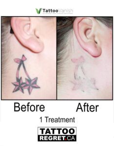 Before and After Tattoo Removal - Get the Best Res