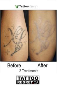 Before and After Tattoo Removal - Get the Best Res (13)