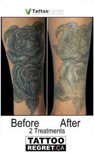 Before and After Tattoo Removal - Get the Best Res (14)