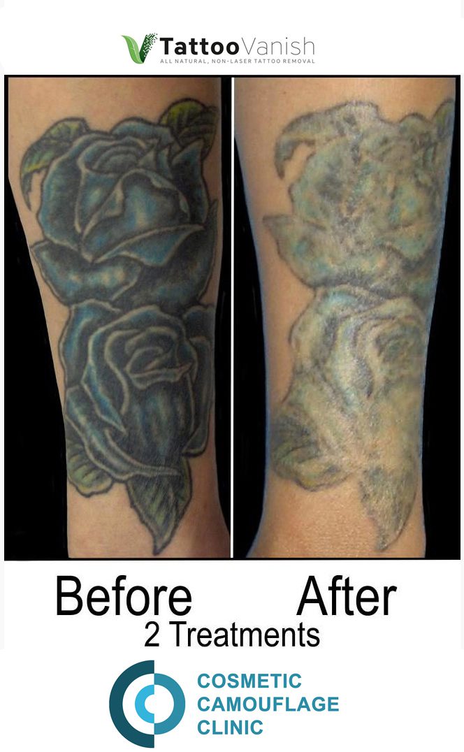 Brookes Tattoo Removal Journey  Pulse Light Clinic London