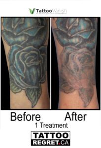 Before and After Tattoo Removal - Get the Best Res (15)