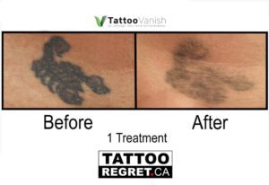 Before and After Tattoo Removal - Get the Best Res (16)