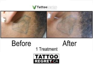 Before and After Tattoo Removal - Get the Best Res (17)