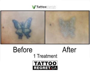 Before and After Tattoo Removal - Get the Best Res (18)