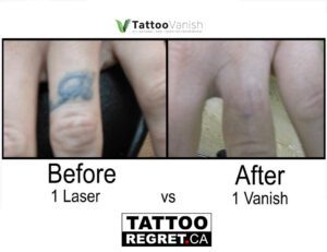 Before and After Tattoo Removal - Get the Best Res (19)