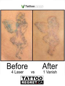 cost of tattoo removal