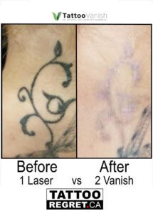 Before and After Tattoo Removal - Get the Best Res (21)