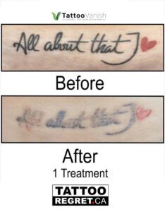 Before and After Tattoo Removal - Get the Best Res (22)