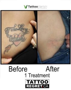 Before and After Tattoo Removal - Get the Best Res (25)