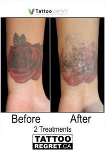 Before and After Tattoo Removal - Get the Best Res (27)