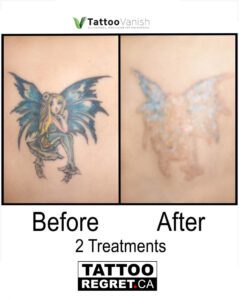 Before and After Tattoo Removal - Get the Best Res (28)