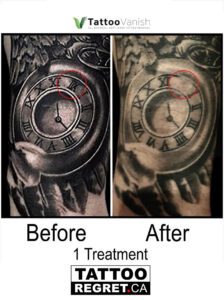 Before and After Tattoo Removal - Get the Best Res (29)