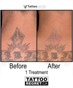 Before and After Tattoo Removal - Get the Best Res (30)