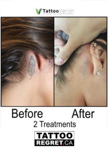 Before and After Tattoo Removal - Get the Best Res (31)