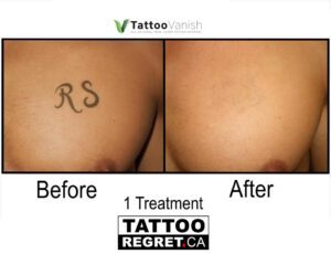 Before and After Tattoo Removal - Get the Best Res (34)