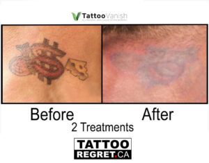 Before and After Tattoo Removal - Get the Best Res (35)