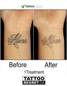 Before and After Tattoo Removal - Get the Best Res (37)