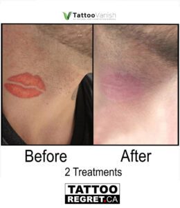 Before and After Tattoo Removal - Get the Best Res (38)