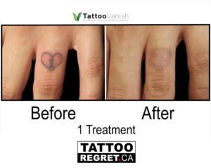 Before and After Tattoo Removal - Get the Best Res (39)