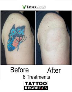 Before and After Tattoo Removal - Get the Best Res (4)