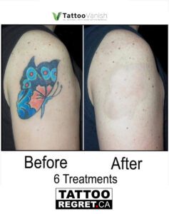 saline tattoo removal