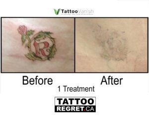 Before and After Tattoo Removal - Get the Best Res (41)