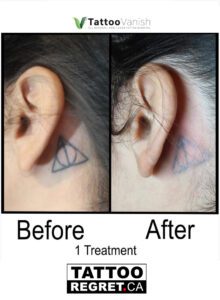 Before and After Tattoo Removal - Get the Best Res (43)