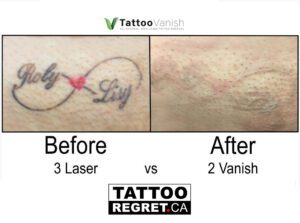 tattoo removal price