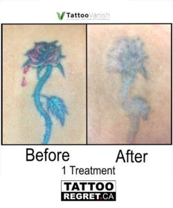 Before and After Tattoo Removal - Get the Best Res (6)