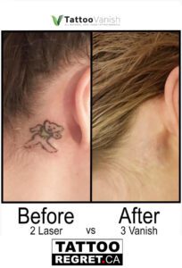 Before and After Tattoo Removal - Get the Best Res (8)