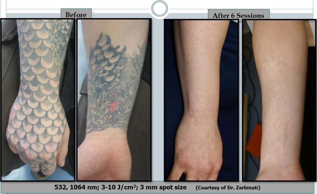 Laser Tattoo Removal Laser And Non Laser Tattoo Removal Tattoo Regret