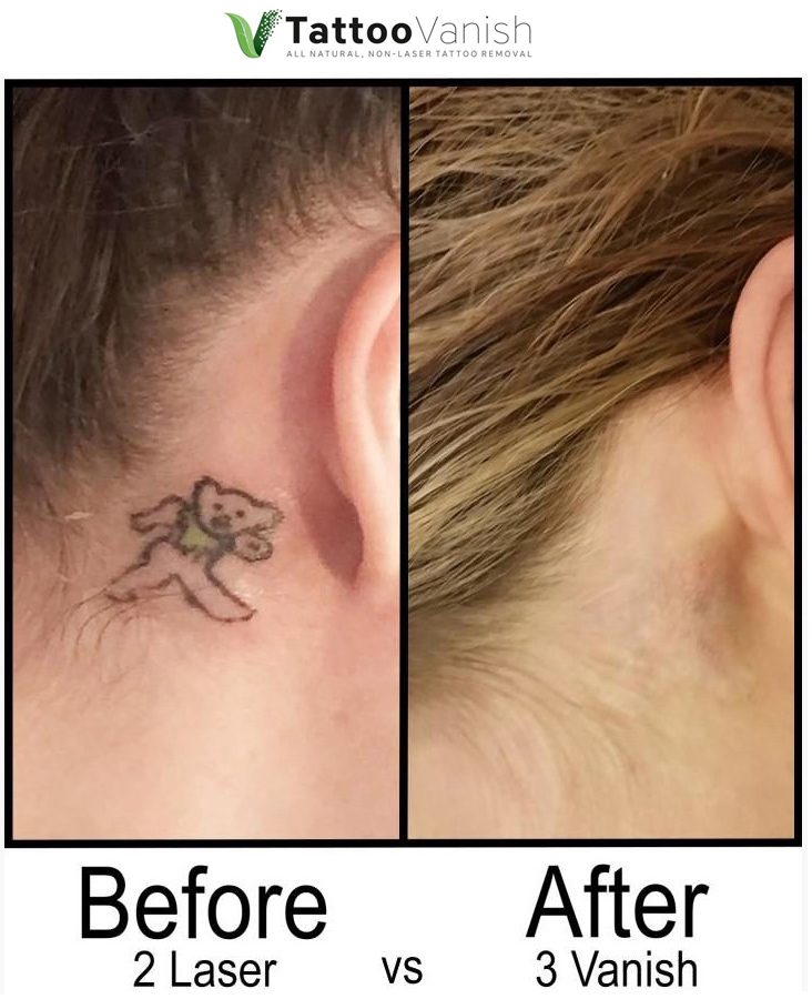 An Overview on Tattoo Vanish Method: Effective Non-Laser Tattoo Removal Treatment