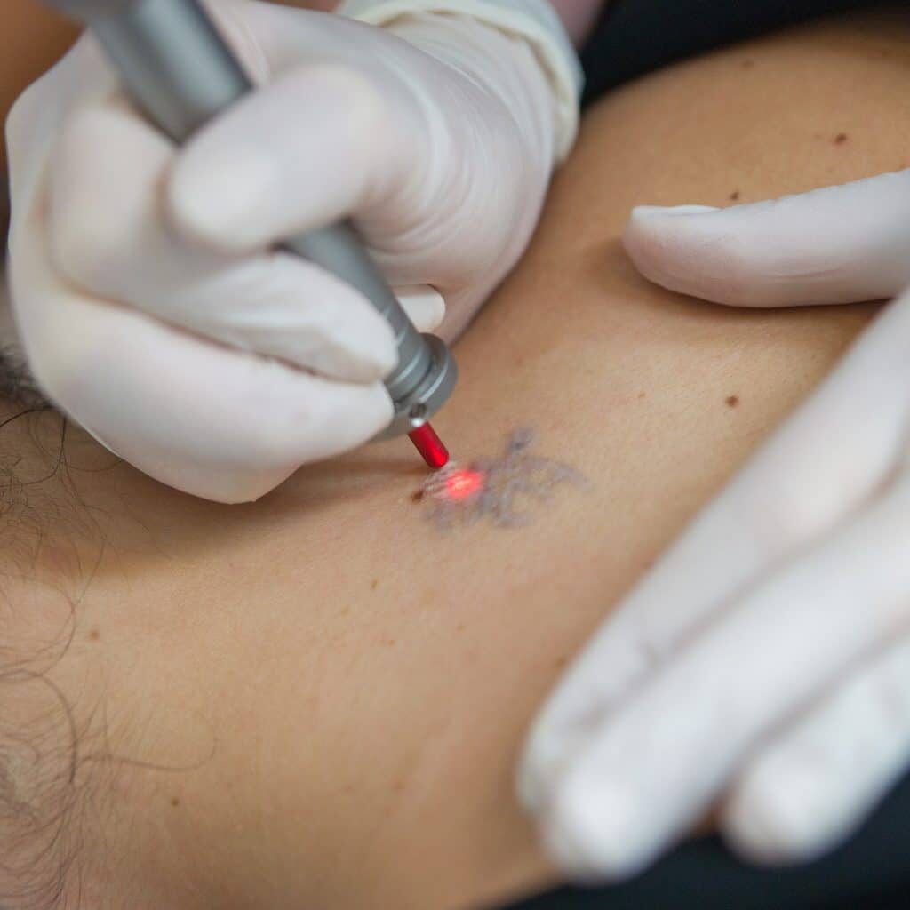 Can Red Ink in a Tattoo Be Removed? | Tatt2Away