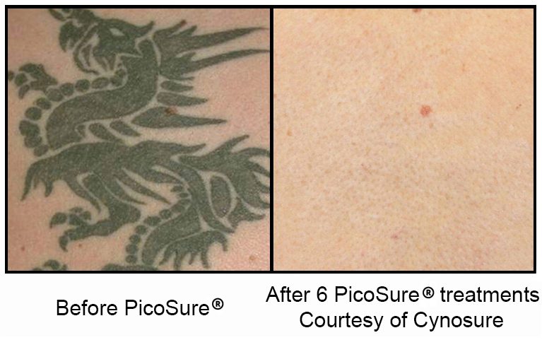 picosure before and after