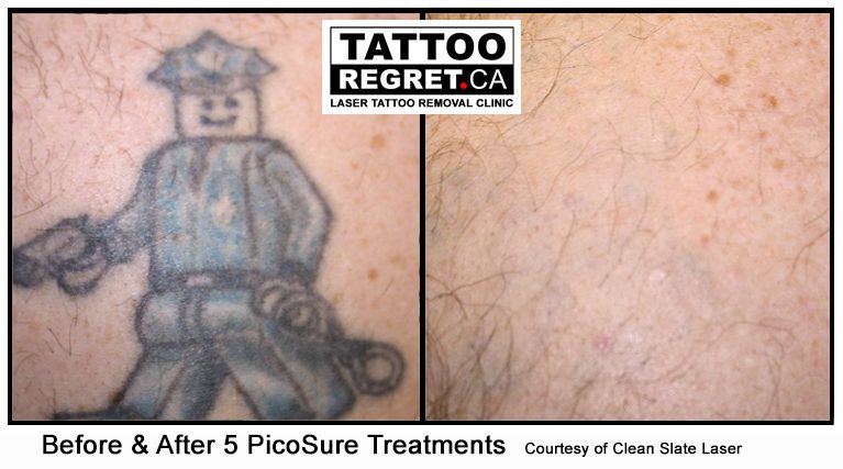 picosure tattoo removal