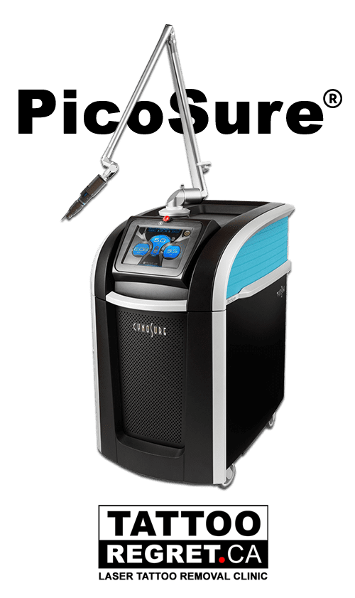 pico laser tattoo removal