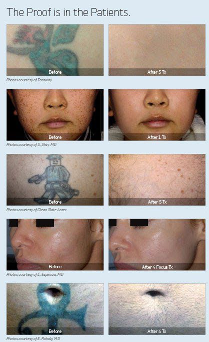 picosure before and after