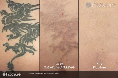 Laser Tattoo Removal - Skinduced Aesthetics Clinic