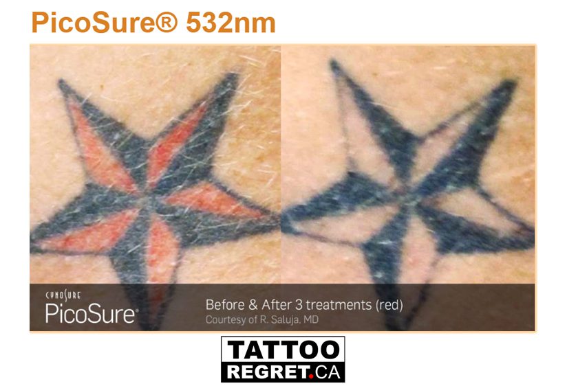 Pico Tattoo Removal Before and After1