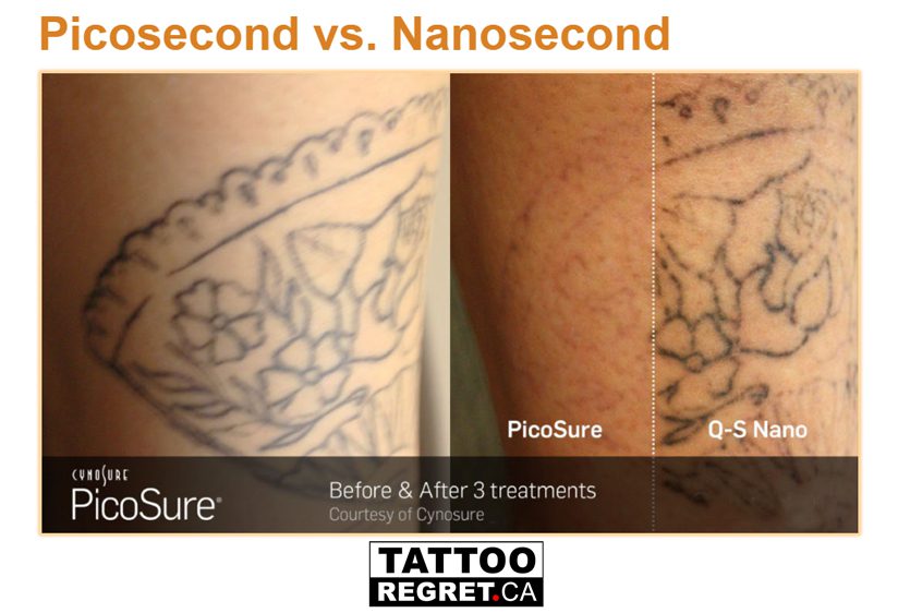 Pico Tattoo Removal Before and After9