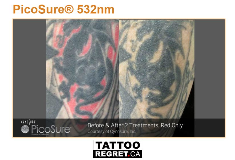 Pico tattoo removal before and after 4