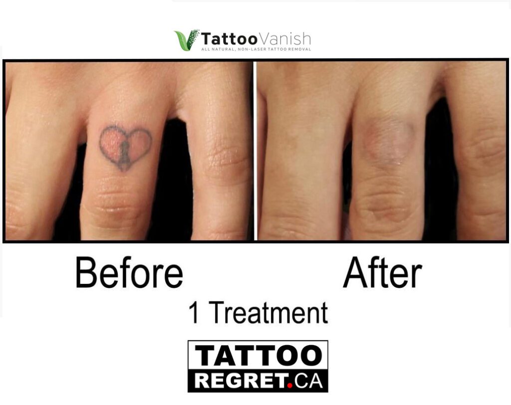 Tattoo Removal Before and After ️ SAVE 197 TATTOOREGRET.CA
