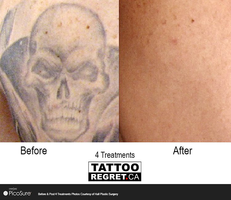 Laser Tattoo Removal: How Long Does it Take to See Results? | FSL