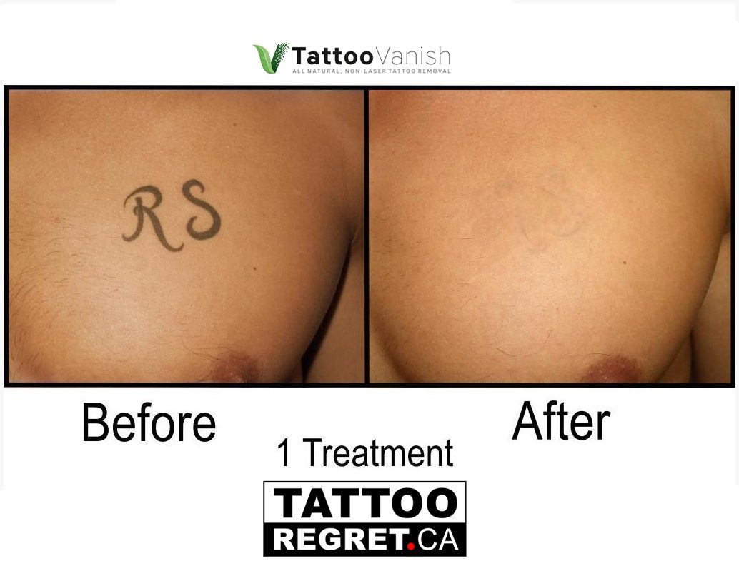 how to remova a tattoo