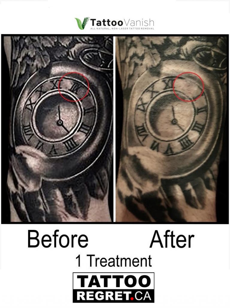 How many sessions to remove tattoo