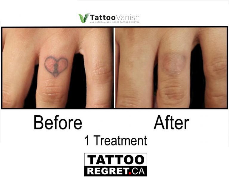 Tattoo Removal Barrie