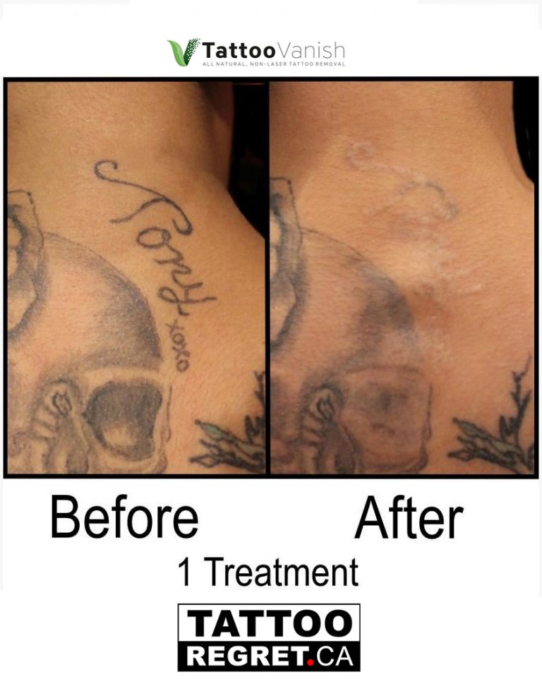 Tattoo Removal Before After