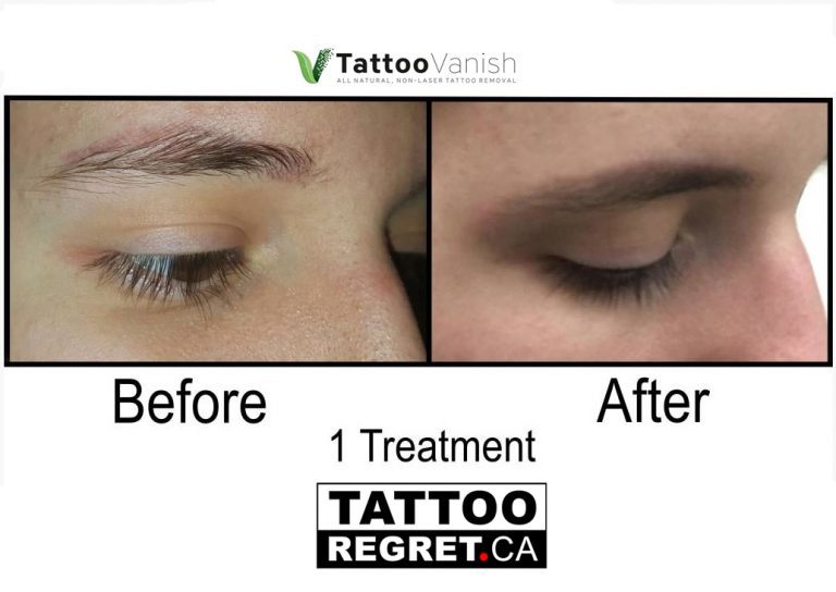 Tattoo Removal Before and After Brampton